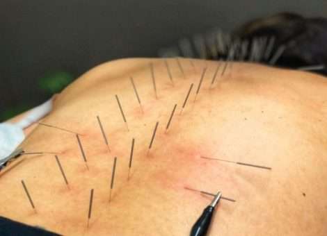 طب سوزنی و درمان آرتروز گردن